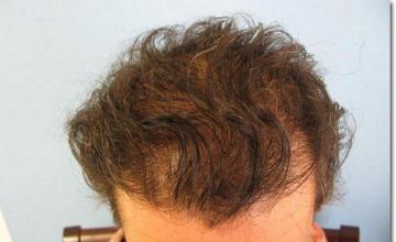 Hair restoration procedure results