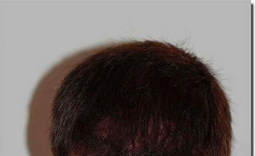 Hair restoration procedure results