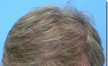 Hair restoration procedure results