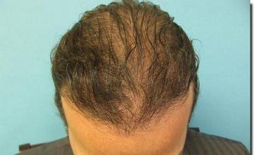 Hair restoration procedure results