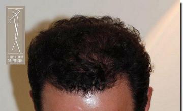 Hair restoration procedure results