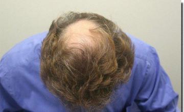 Hair restoration procedure results