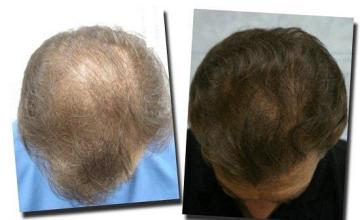 Hair restoration procedure results