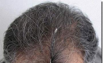 Hair restoration procedure results