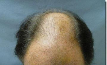 Hair restoration procedure results