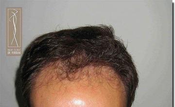 Hair restoration procedure results