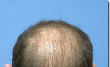 Hair restoration procedure results