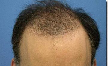 Hair restoration procedure results