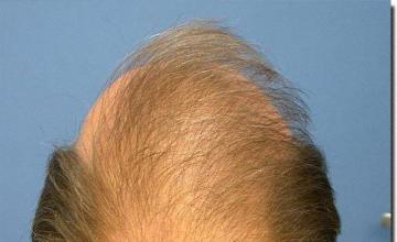 Hair restoration procedure results