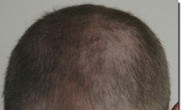 Hair restoration procedure results