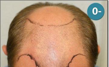 Hair restoration procedure results
