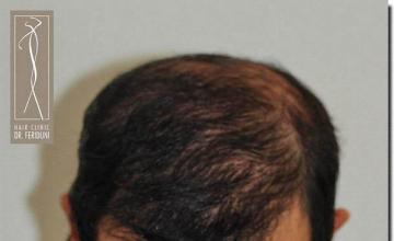 Hair restoration procedure results