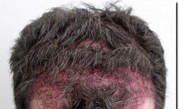 Hair restoration procedure results