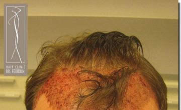 Hair restoration procedure results