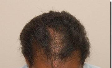 Hair restoration procedure results