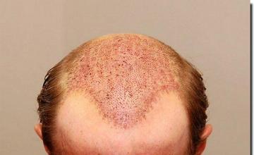 Hair restoration procedure results