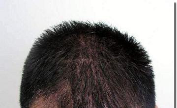 Hair restoration procedure results