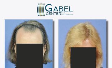 Hair restoration procedure before and after results