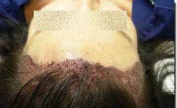 Hair restoration procedure results