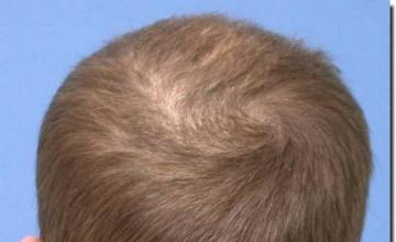 Hair restoration procedure results