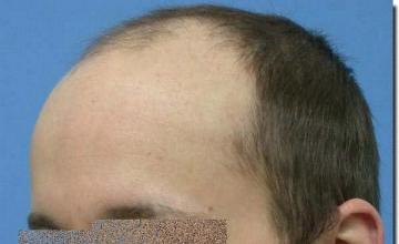 Hair restoration procedure results