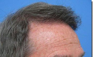 Hair restoration procedure results