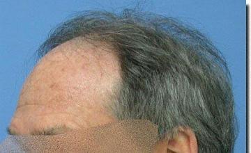 Hair restoration procedure results