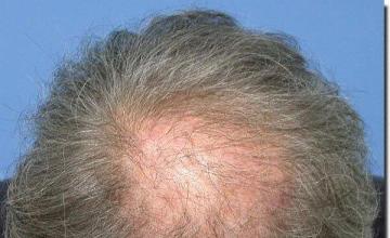 Hair restoration procedure results