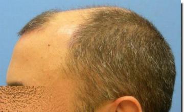 Hair restoration procedure results