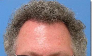 Hair restoration procedure results