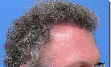 Hair restoration procedure results