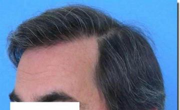 Hair restoration procedure results