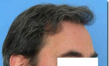 Hair restoration procedure results