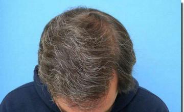 Hair restoration procedure results