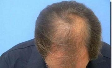 Hair restoration procedure results