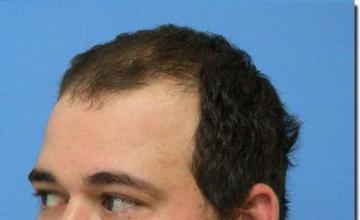 Hair restoration procedure results