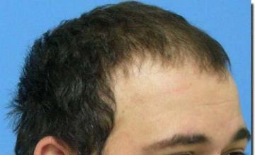 Hair restoration procedure results