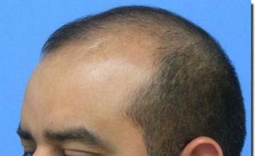 Hair restoration procedure results