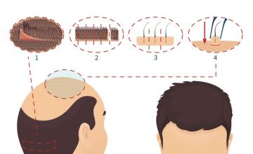 Follicular Unit Transplant