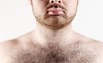 Body Hair Transplant