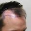 FUE Hair Transplant Procedure