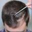 Hair transplantation FAQs