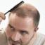 Hair Loss Lotions, Potions and "Cures"