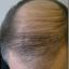 Hair Transplant Repair